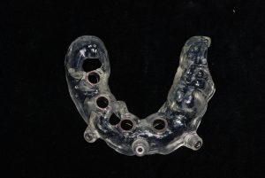 implantologia-dentale-guidata