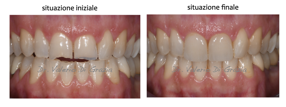 Ricostruzione dentale: alcuni esempi (parte 1)